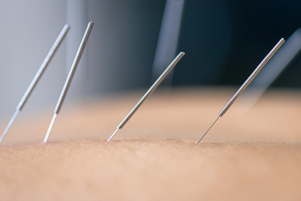 agulhas de acupuntura secas no paciente close up