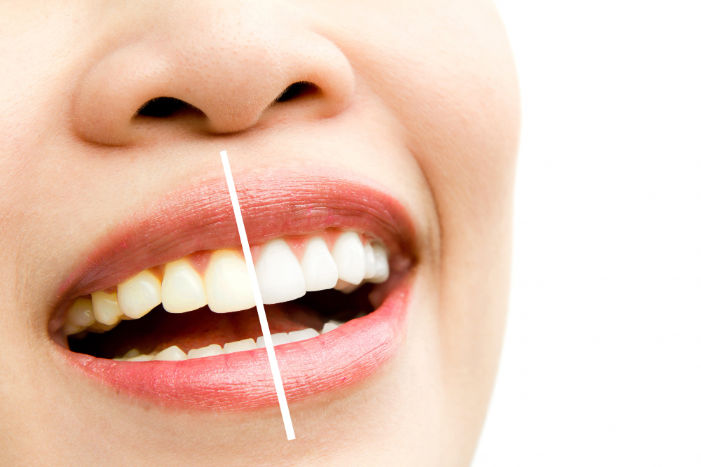 Quais são as formas para clarear os dentes? 3 Cafe mancha os dentes