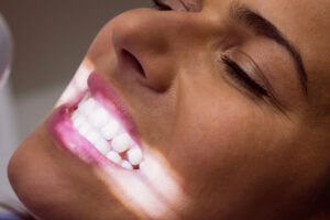 formas de branquear os dentes 2