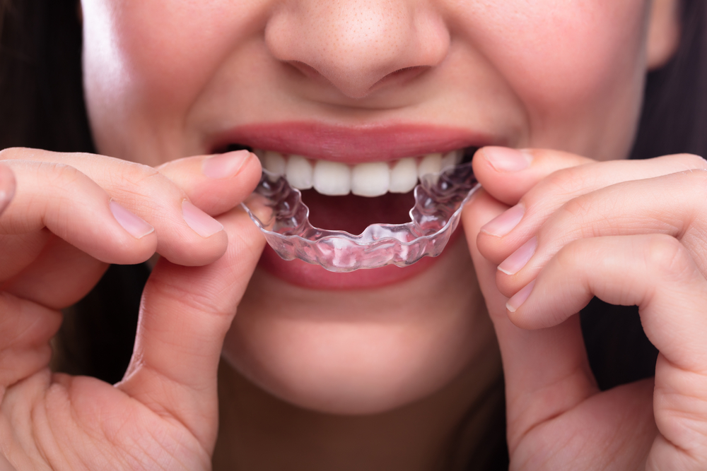 Manutenção e Cuidados da Reabilitação Oral: Longevidade do Novo Sorriso 4 Bruxismo nos dentes